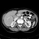 Lymphatic node, nodus foramen Winslowi, enlarged in hepatitis B and hepatitis C: CT - Computed tomography
